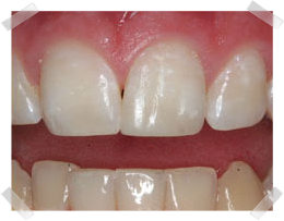 cosmetic dentistry after bonding