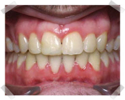 cosmetic dentistry after braces