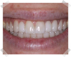 cosmetic dentistry after bridges