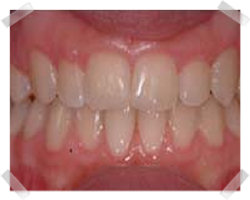 cosmetic dentistry after clear step