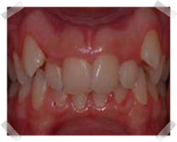 cosmetic dentistry before clear step