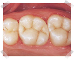 cosmetic dentistry after composite fillings