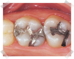 cosmetic dentistry before composite fillings