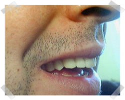 cosmetic dentistry after dentures