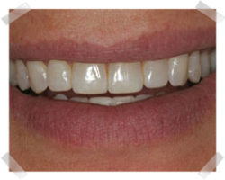 cosmetic dentistry after enamel shaping