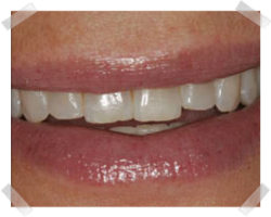 cosmetic dentistry before enamel shaping