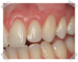 cosmetic dentistry after gum grafts