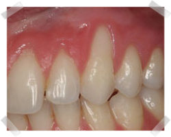 cosmetic dentistry before gum grafts