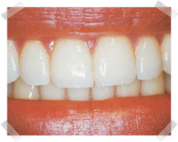 cosmetic dentistry after gum reshaping