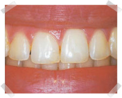 cosmetic dentistry before gum reshaping