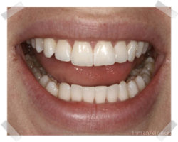 cosmetic dentistry after inman aligner
