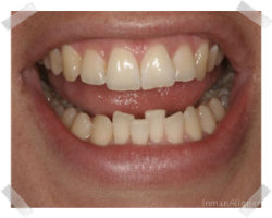 cosmetic dentistry before inman aligner