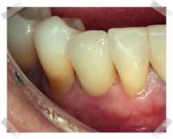 cosmetic dentistry after root implants