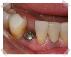 cosmetic dentistry before root implants