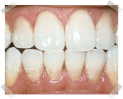 cosmetic dentistry after teeth whitening