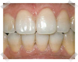 cosmetic dentistry before teeth whitening