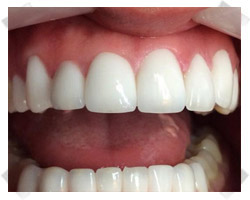 cosmetic dentistry after crowns