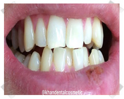 cosmetic dentistry before crowns