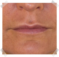 dermal fillers after nose to lip enhancement