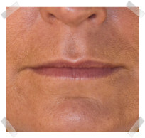 dermal fillers before lip enhancement