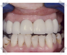 cosmetic dentistry after poor teeth and gums