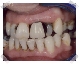 cosmetic dentistry before poor teeth and gums