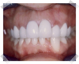 cosmetic dentistry after crooked teeth