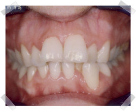 cosmetic dentistry before crooked teeth