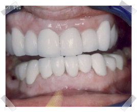 cosmetic dentistry after dark teeth