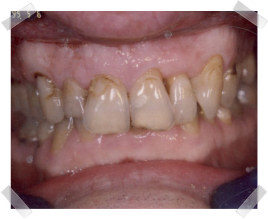 cosmetic dentistry before dark teeth