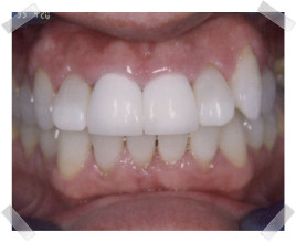 cosmetic dentistry after old crown