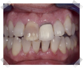 cosmetic dentistry before old crown