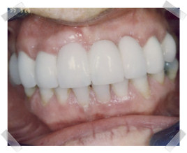 cosmetic dentistry after loss of anterior teeth