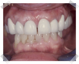 cosmetic dentistry after old fillings