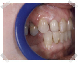 cosmetic dentistry before old fillings