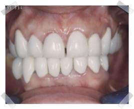 cosmetic dentistry after aged worn dentition