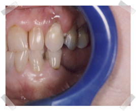 cosmetic dentistry before aged worn dentition