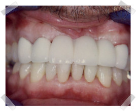 cosmetic dentistry after missing teeth