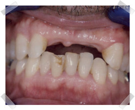 cosmetic dentistry before missing teeth