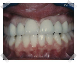cosmetic dentistry after gap between teeth