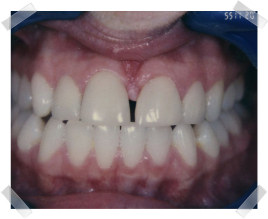 cosmetic dentistry before gap between teeth