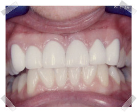 cosmetic dentistry after crooked anterior teeth
