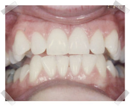 cosmetic dentistry before crooked anterior teeth
