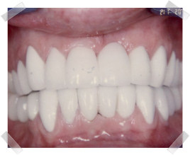 cosmetic dentistry after old crown and bridgework