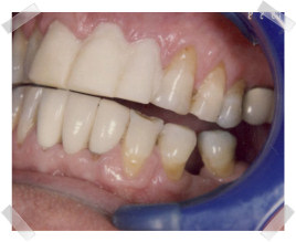 cosmetic dentistry before old crown and bridgework