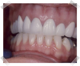 cosmetic dentistry after crooked upper anterior teeth