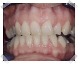 cosmetic dentistry before crooked upper anterior teeth