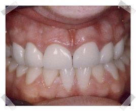 cosmetic dentistry after chipped anterior teeth