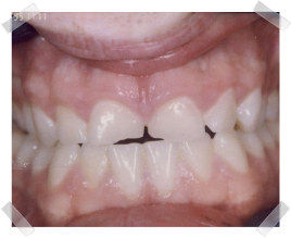 cosmetic dentistry before chipped anterior teeth