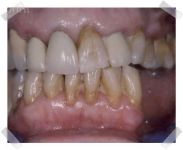 cosmetic dentistry before aged dentition